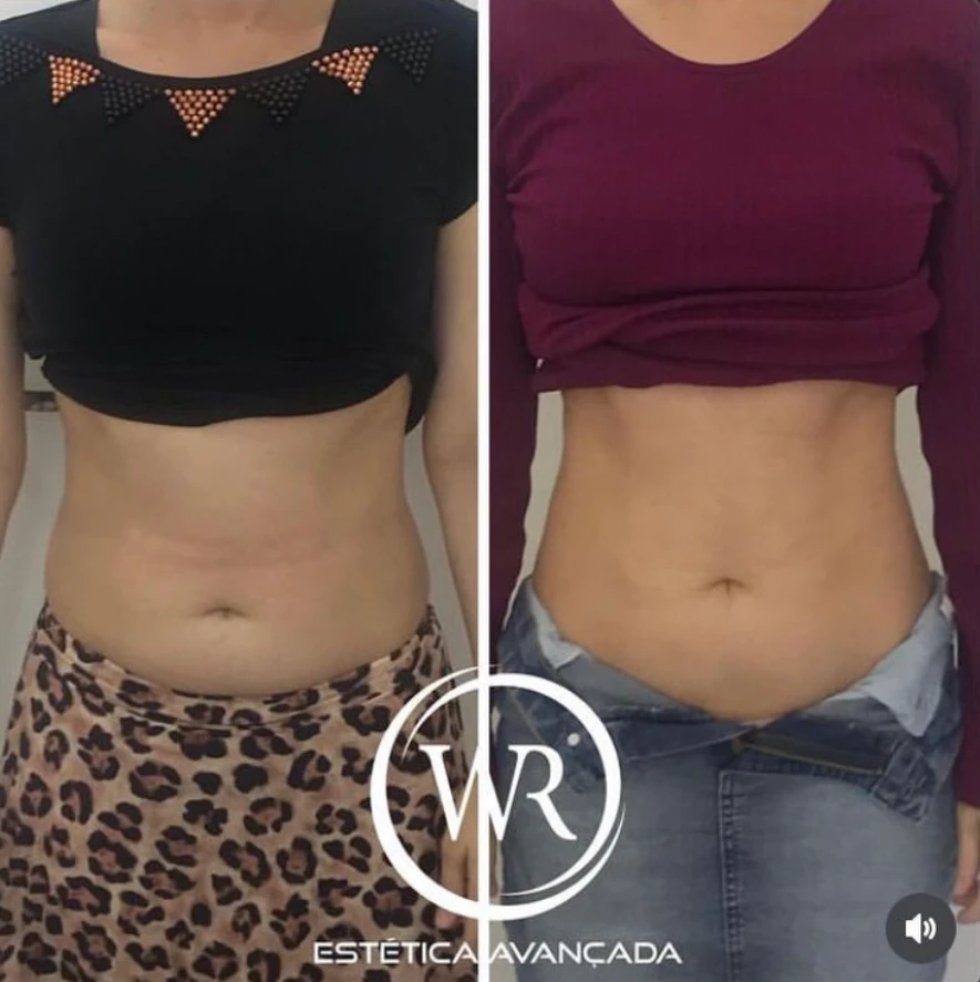 Antes e depois corporal feminino WR