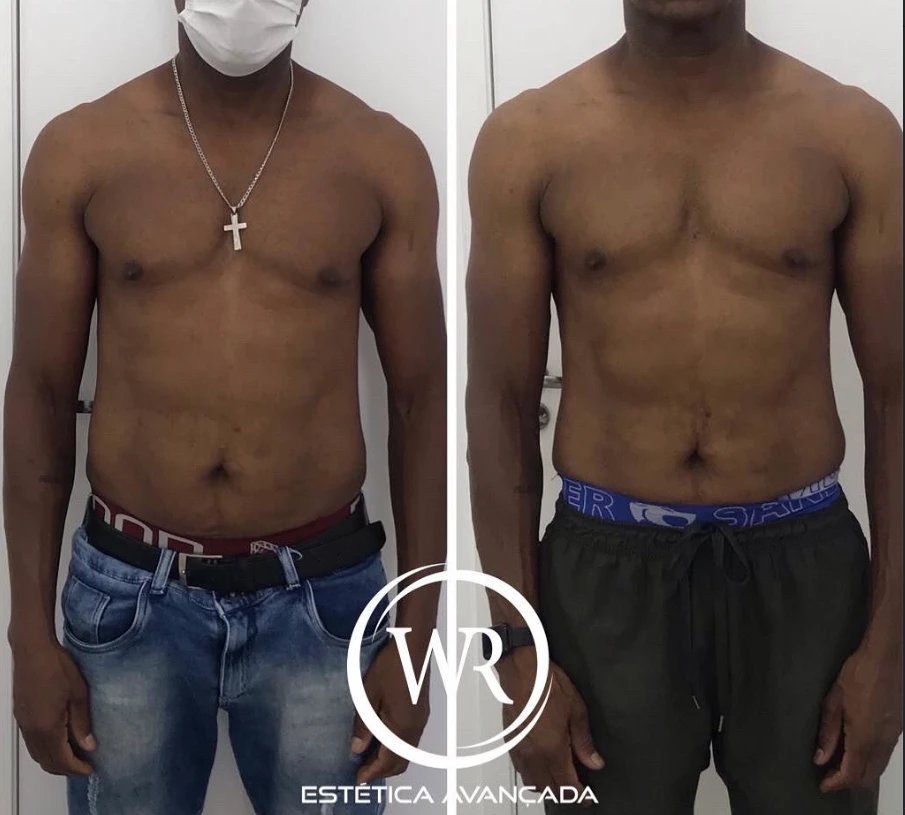 Antes e depois corporal masculino WR 2