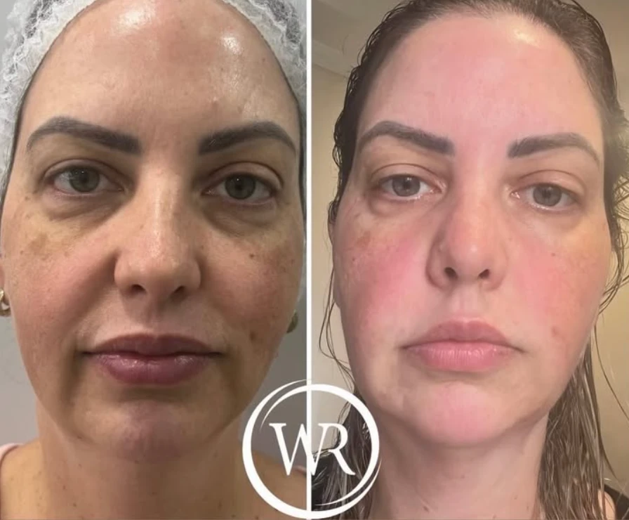 Antes e depois facial WR